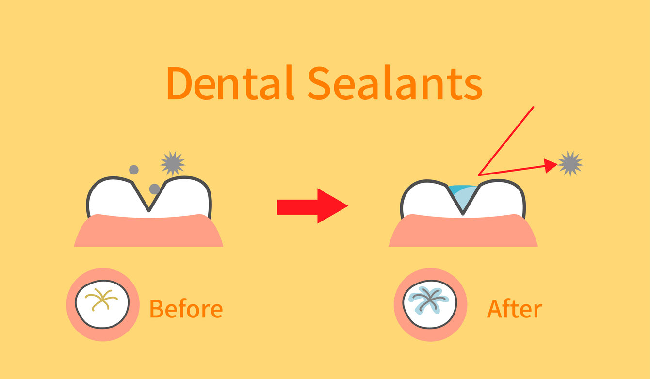 A drawn "Before" image of a tooth without a dental sealant with small gray dots representing bacteria landing on it, beside an "After" image of a tooth with a dental sealant which a gray dot bounces off of.